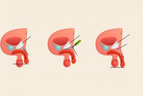 penis büyütme ameliyatı öncesi ve sonrası